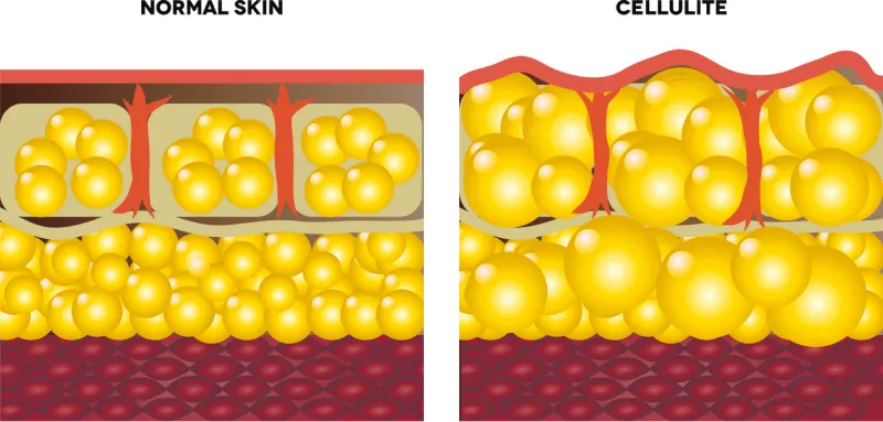 Rappresentazione grafica grasso nella pelle normale e nella cellulite